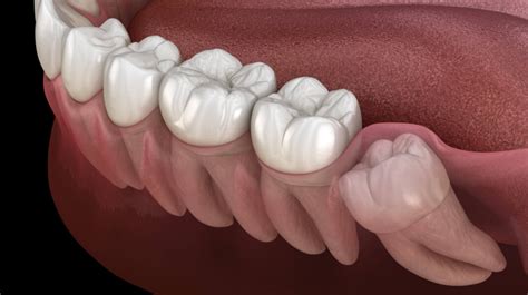 Frequently Asked Questions About Wisdom Teeth Vero Elite Dentistry