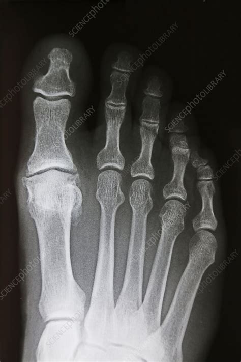 Osteoarthritis Of Big Toe X Ray Stock Image C0272782 Science