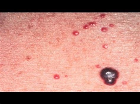 They can also be known as cherry angiomas and consist of bright red small raised spots that tend to occur mainly on the main trunk of. DermTV - What Are Cherry Hemangiomas [DermTV.com Epi #340 ...