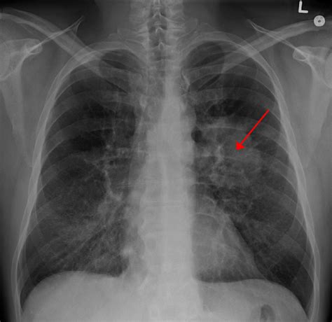 A normal posteroanterior (pa) chest radiograph of someone with interstitial pneumonia. Chest X-ray Interpretation | A Structured Approach ...