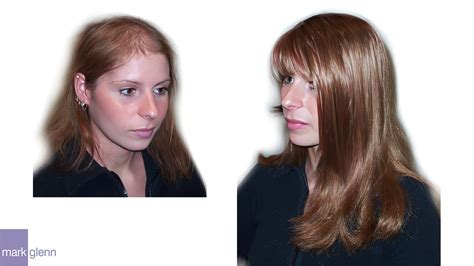 female hair loss before and after hair replacement specialist makeover mark glenn london uk