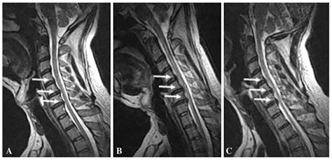 Cervical Disc Bulge In A 40 Year Old Man In The Neutral Position A