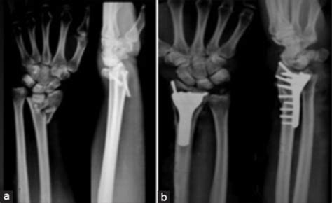 Distal End Radius Fracture X Ray Broken Wrist Treatment In Raleigh