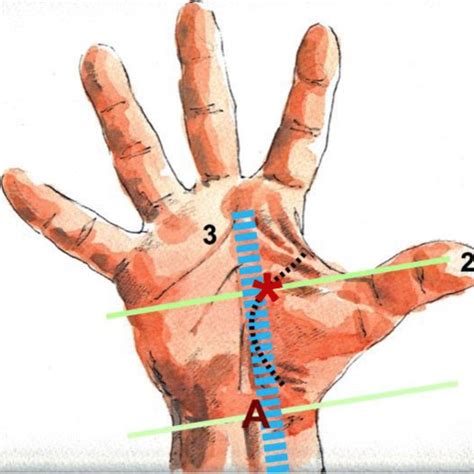 Case Volar Aspect Of Right Hand Wrist To The Right And Fingers To Download Scientific