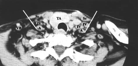 Imaging Based Nodal Classification For Evaluation Of Neck Metastatic