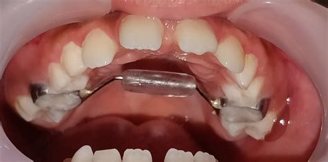 Painless Tongue Tie Treatment In Children Best Pediatric Dentist In Dubai