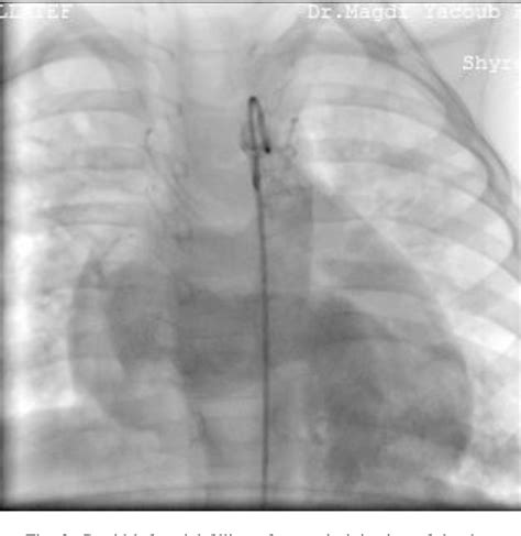 Figure 2 From A Rare Cause Of Machinery Murmur Aorta To Left Lower