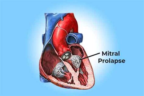 Mitral Valve Prolapse Treatment Ayurvedic Treatment For Heart Problem