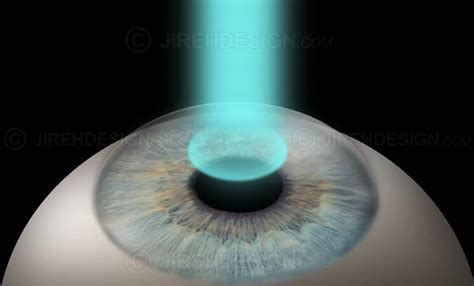 Photorefractive Keratectomy Surpk0002 Stock Eye Images