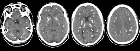 Non Contrast Brain Computed Tomography Scan Showing Extensive And
