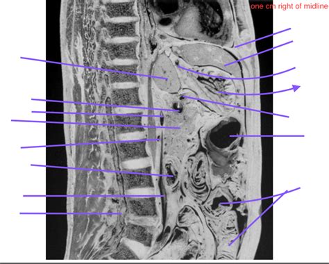 Sagittal Slice 5 Abdomen 1cm Right Of Midline Diagram Quizlet