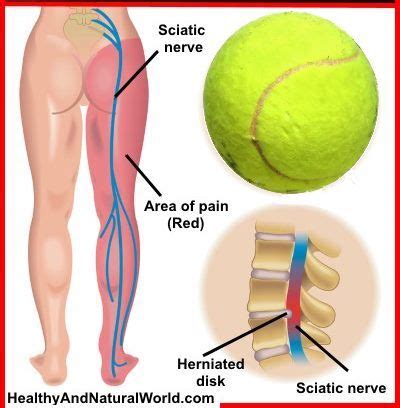 Sciatic Nerve Exercises With Tennis Ball Online Degrees