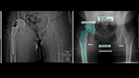 Primary Total Hip Replacement Templating Youtube