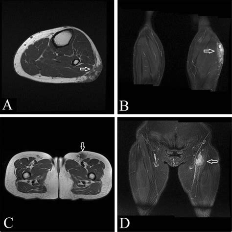 The Imaging Mri Of The Tumor Mri Shows Multiple Subcutaneous Nodules