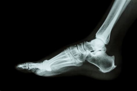 Xray Normal Foot Lateral Stock Photo Download Image Now Istock