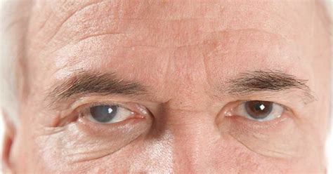 Detecci N Y Tratamiento De Glaucoma Yag Ocular