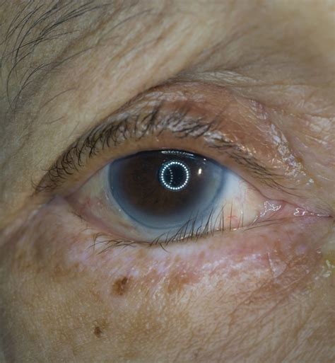 Eyelids And Upper Face Diseases Ophthalmology Bellevue Clinic
