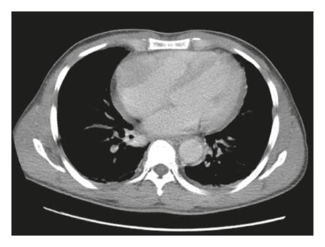 Ac Ct Imaging Of The Chest Without Contrast The Heart Is Normal In