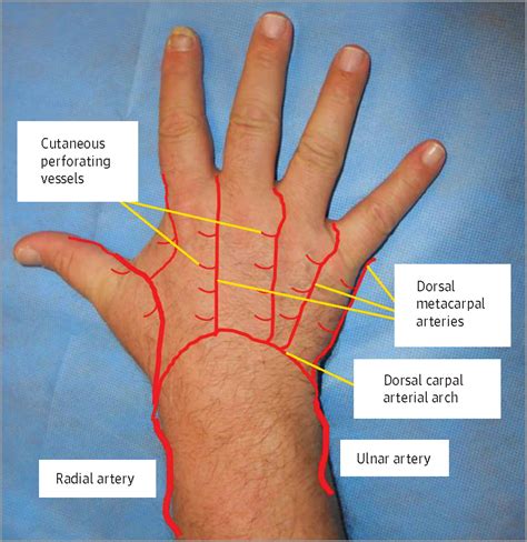 Local Fasciocutaneous Sliding Flaps For Soft Tissue Defects Of The Dorsum Of The Hand