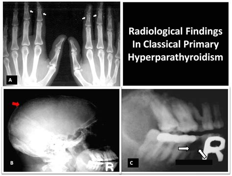 Primary Hyperpt A Xray Of The Hands Showing Subperiosteal Bone