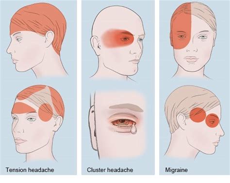 How Do Common Types Of Headaches Differ