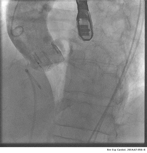 Transcatheter Aortic Valve Replacement With Lotus Valve Initial