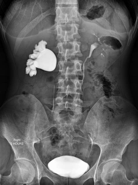 Ureteropelvic Junction Obstruction Image