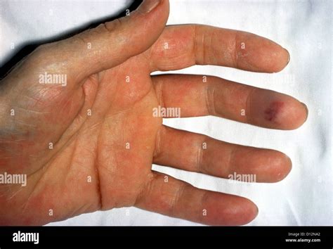 Patient With Subacute Bacterial Endocarditis Stock Photo Alamy