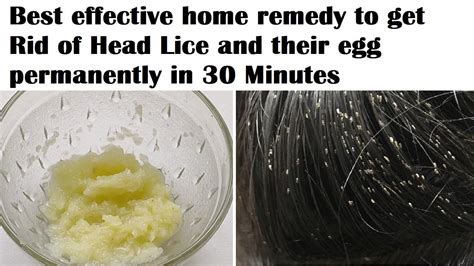 Best Home Remedy To Get Rid Of Head Lice And Their Eggs Permanently In