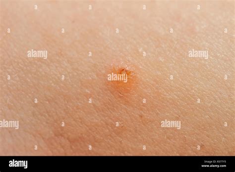 Close Up Of Molluscum Contagiosum Also Called Water Wart Stock Photo