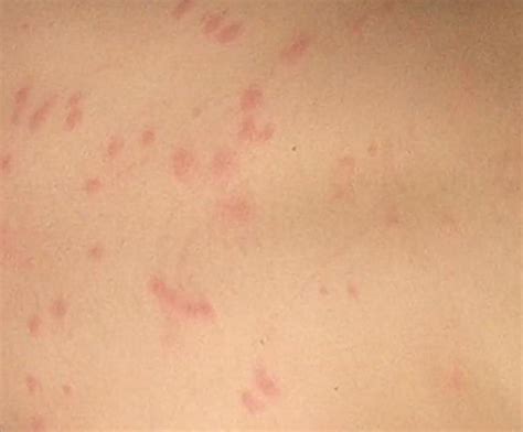 A Mysterious Rash Is Spreading Among Children And Staff At An
