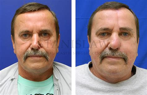 Nose Skin Cancer Gallery 1 Before And After Photos Connecticut
