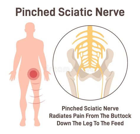 Sciatic Nerve Piriformis Stock Illustrations Sciatic Nerve Piriformis Stock Illustrations