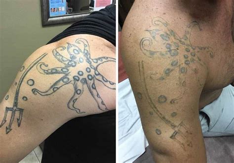 Positions include being a medical esthetician, a tattoo removal specialist, or a cosmetic laser technician. Tattoo Removal Progress Picture - After just three sessions. #reversatatt #tattooremoval ...