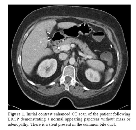 Adenocarcinoma Of The Pancreas Undetected By Multidetector