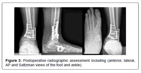 Clinical Research Foot Saltzman Views