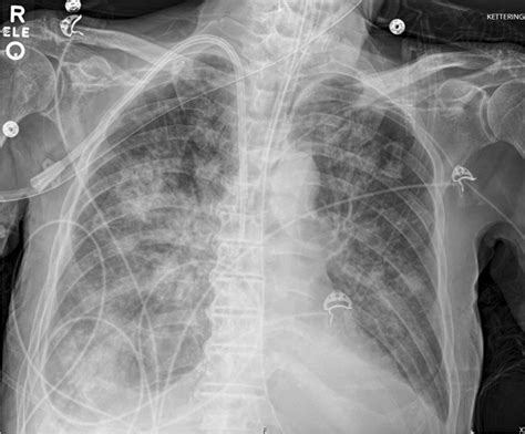 Chest X Ray Demonstrating Bilateral Widespread Airspace Disease