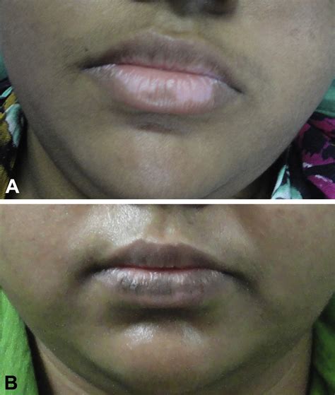An Innovative Use Of An Aerosol Spray In Surgical Management Of Lip