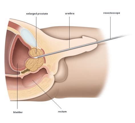 Diy Urethral Sounding Tools Mega Porn Pics