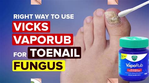 Top 5 Fungus Remedies In Your Home Youtube