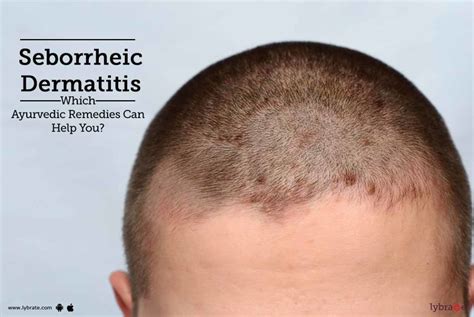 How To Treat Seborrheic Dermais Hair Loss Tutorial Pics