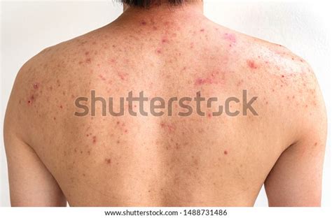 Men Acne Red Spots On Back Stock Photo Edit Now 1488731486