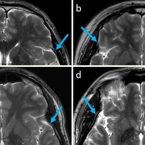 Ad Axial T Weighted Magnetic Resonance Images Of Different Adult