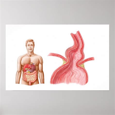 Medical Ilustration Of A Hiatal Hernia In The Poster