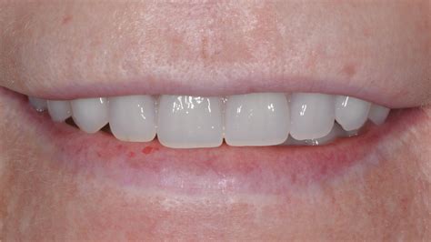 Smile Dental Implants Infinity Dental Clinic