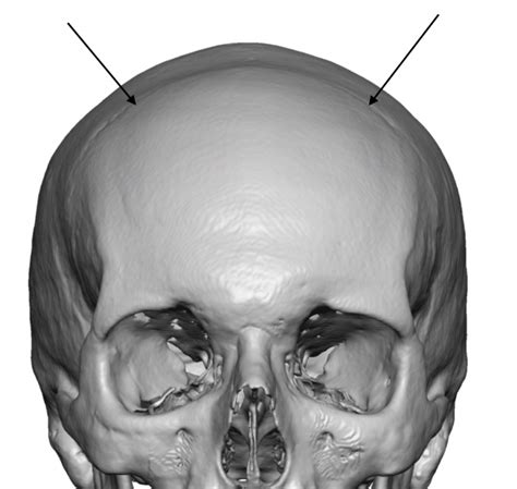 Plastic Surgery Case Study The Coronal Dip Custom Skull Implant