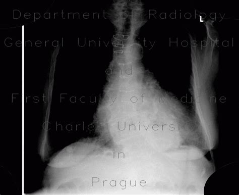 Radiology Case Hiatal Hernia Chest Radiograph