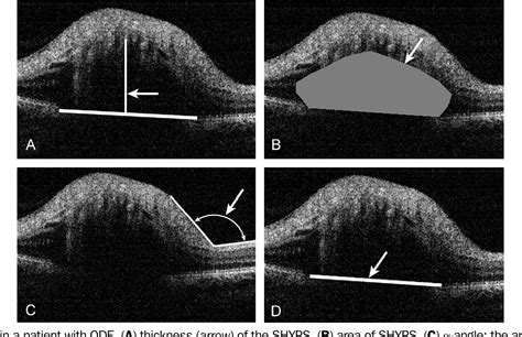 Figure 1 From Differentiation Of Optic Disc Edema From Optic Nerve Head