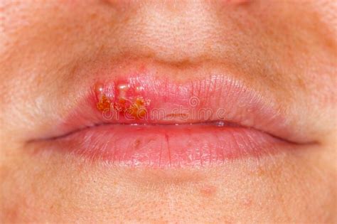 #eye trauma #herpes #herpes simplex #keratitis #eye #medical #ophthalmology #medicine #own posts. Oral Herpes Simplex Virus Infection Stock Photo - Image of crusted, medical: 179476342