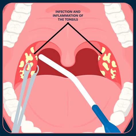 Best Tonsil Removal Tonsillectomy Surgery Treatment In Dhayari At